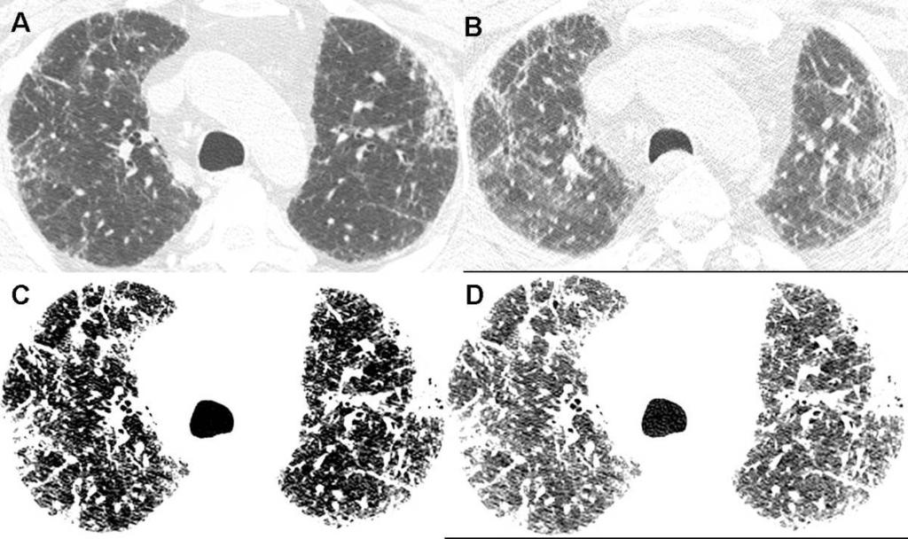 Fig. 6: A and B inspiratory and expiratory images (window width 1500, window level -700 HU) at the aortic arch level show bilateral areas of lung fibrosis.