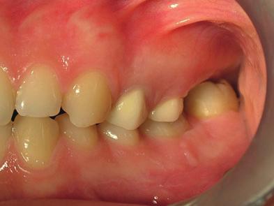A Arslan et al. Fig 1. Intraoral view of the overerupted left mandibular second molar. Fig 3.