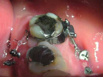 Intrusion of an overerupted mandibular molar beginning of the treatment, the upper screw was initially to be used to apply the retraction force to intrude the overerupted molar and the other was kept