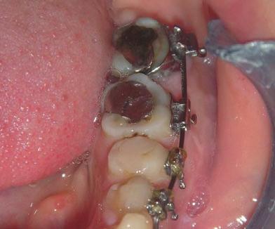 Intrusion was done with elastics applied to screws located buccally and lingually.