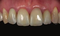application for single tooth restorations form an alternative to the metal ceramic gold standard.