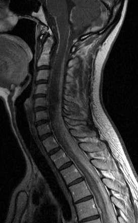Localisation Dorsal spine (40-60%) Lumbar