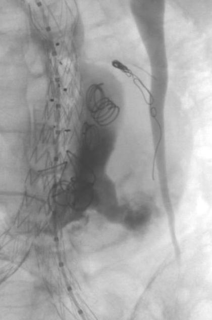 9% Completion angiography: Type II endoleak 38 23.