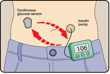 Control-IQ Technology: Automated insulin for better glycemic control Why