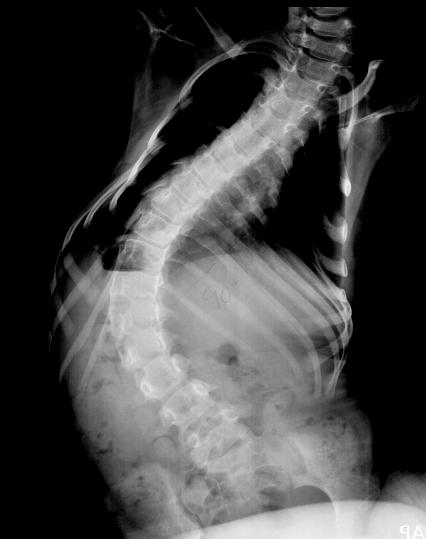 Spinal Muscle Atrophy Anterior horn cells Most common lethal NM disease of infancy Three types