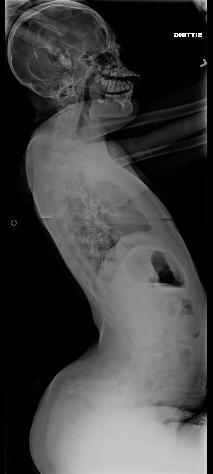 NM Scoliosis Long C curve Pelvic obliquity Hip