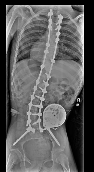 Operative Tx Posterior Spinal