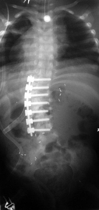 Operative Tx Anterior Spinal Fusion Myelodysplasia Lumbar scoliosis