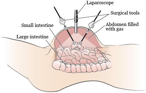 PATIENT & CAREGIVER EDUCATION Diagnostic Laparoscopy This information describes your diag nostic laparoscopy.