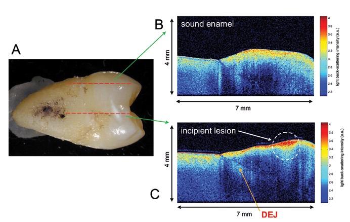 Early Caries Detection A B light back-scattering intensity C light back-scattering intensity Figure 1: (a) Mesial surface of an extracted human premolar (tooth 15) with an incipient lesion.