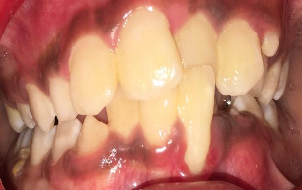 of this type of malocclusion is to correct anterior cross bite, as otherwise it can often lead to very serious Class III malocclusion which necessitates complex combined orthodontic and orthognatic