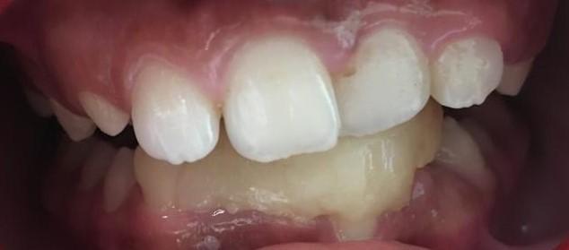 5-8 The following article, elaborates three cases of anterior cross bite managed with different approaches with composite inclined plane, Hawley s appliance with Z-spring and posterior bite plane and
