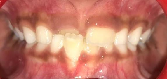 this case Z- spring was indicated as there was adequate space for the labialization of the maxillary lateral incisor.
