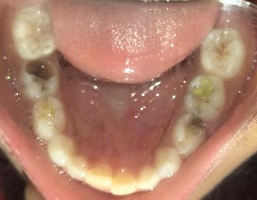 Excellent patient cooperation resulted in early correction of the cross bite [Figure 8]. Appliance was continued for a further 2 weeks for maintenance of correction.