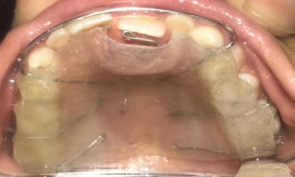 weeks Case 3 A 12 year-old girl reported to the department of Paediatric and Preventive dentistry with the chief complaint of unnesthetic appearance.