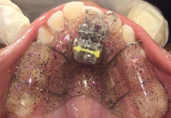 continues to progress leading to severe malocclusion. Thus early treatment can reconstruct proper muscle balance and a well-balanced occlusal development.