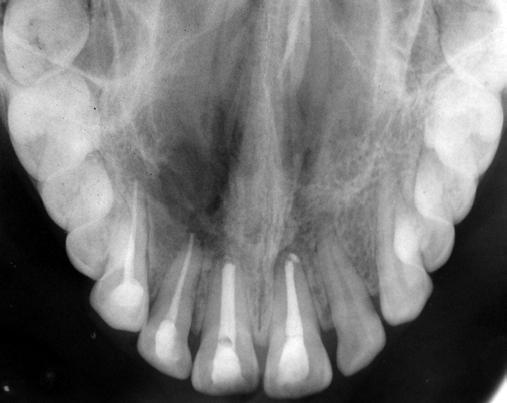 root canal, i.e., intracanal Figure 4: Radiograph at the 1½-year follow-up infection.