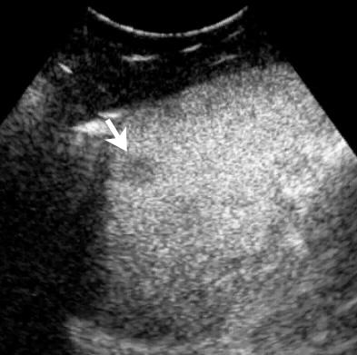 Statistical analysis showed no significant association between the contrast-enhanced sonographic pattern and size (P =.