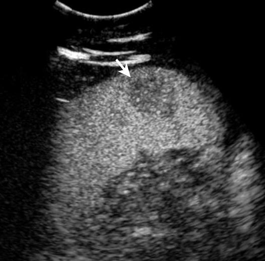 On sonography, a splenic hemangioma may appear either as a well-defined hyperechoic lesion, usually smaller than 2 cm and