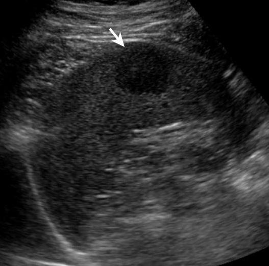 12 Furthermore, sonographic appearances of spleen disease are rather nonspecific, and differentiation between benign and malignant