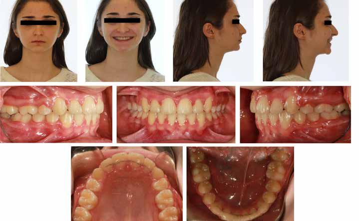 Extraoral and intraoral photographs at the end of