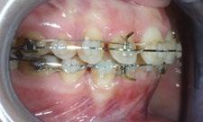 take place only in correspondence of the second premolars and