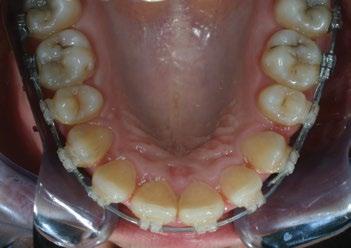 arch can change the alignment of teeth and close spaces