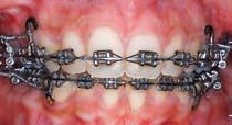 21 According to Chen and colleagues, the critical factors for success of orthodontic miniscrews are initial mechanical stability and
