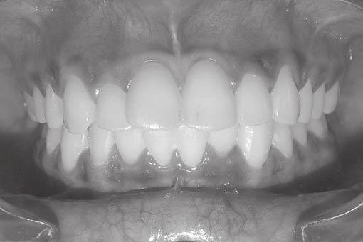 A Modified Three-piece Base Arch for en masse Retraction and Intrusion in a Class II Division 1 Subdivision Case Fig. 2: Pretreatment intraoral frontal view Fig.