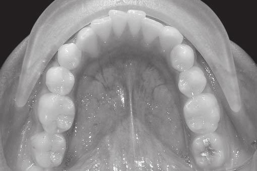 occlusion, midline correspondence, appropriate overjet, and adequate retraction of the flared upper and lower incisors.