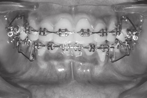 The tip back bends were incorporated mesial to the auxiliary tube on the maxillary first molars and the springs were inserted into the tube.