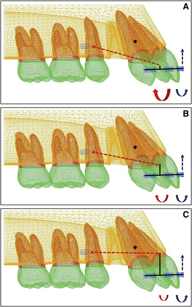 e190 Mo et al of temporary skeletal anchorage devices. When using this technique, one must consider the center of resistance of the anterior segment to retraction in each patient.