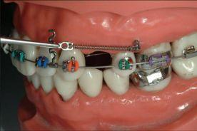 6. Timing for orthodontic force Orthodontic force is generally less than 300gm, so early mechanical stability is enough for immediate orthodontic force.