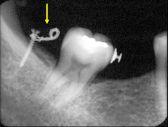 area for uprighting of mandibular 2 nd molar (Fig 24).