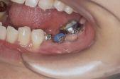 Bracket or any kind of attachments can be attached to the microimplants using light curing composite resin.