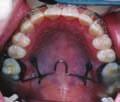 5) treated in 20 months with maxillary en masse dental protraction using TPA constructed from the distolingual line angles of the