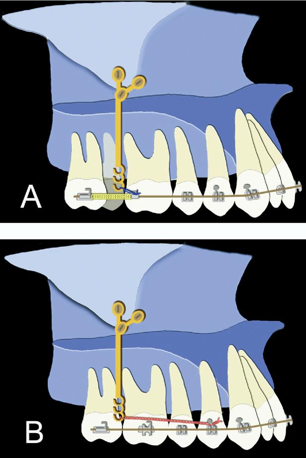 726 Sugawara et al June 2006 Fig 2. SAS biomechanics for distal movement of maxillary molars. A, Single molar distal movement; B, enmasse molar distal movement.