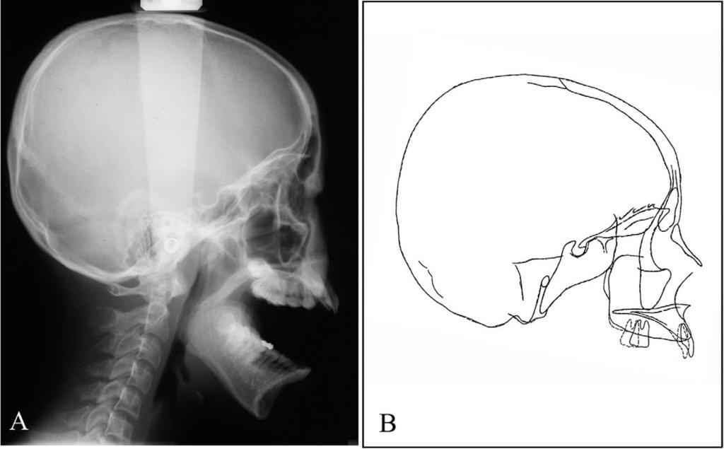 Volume 129, Number 6 Sugawara et al 727 Fig 3. A, Roentgen cephalometric film in wide-opening; B, cephalometric superimposition before and after SAS treatment.