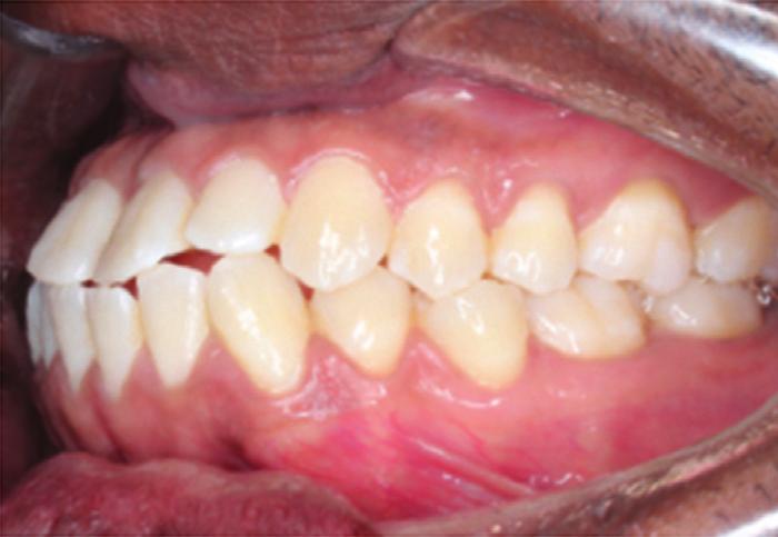 The dental casts (Figure 2) showed 2 mm maxillary midline diastema and mild crowding (3-4 mm) in the mandible.