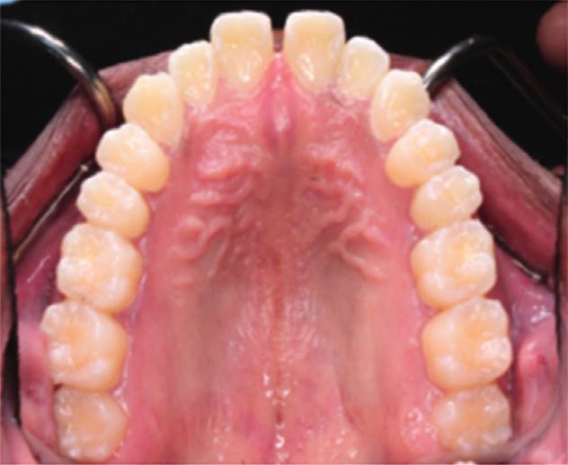 His mandibular third molars were impacted horizontally (Figure 3(a)).