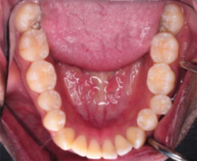 5 mm) with bialveolar dental protrusion and increased lower anterior facial height. The maxillary and mandibular incisors were proclined resulting in decreased interincisal angle.