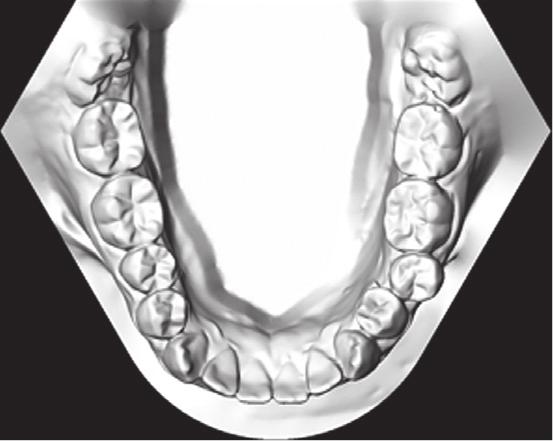 CaseReportsinDentistry 3 Figure 2: Pretreatment dental casts.