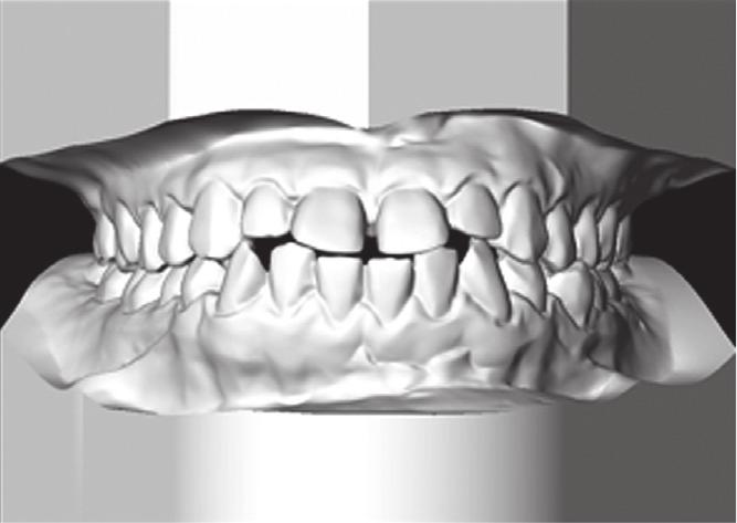 Therefore, the patient s treatment plan would entail nonextraction camouflage treatment by mandibular