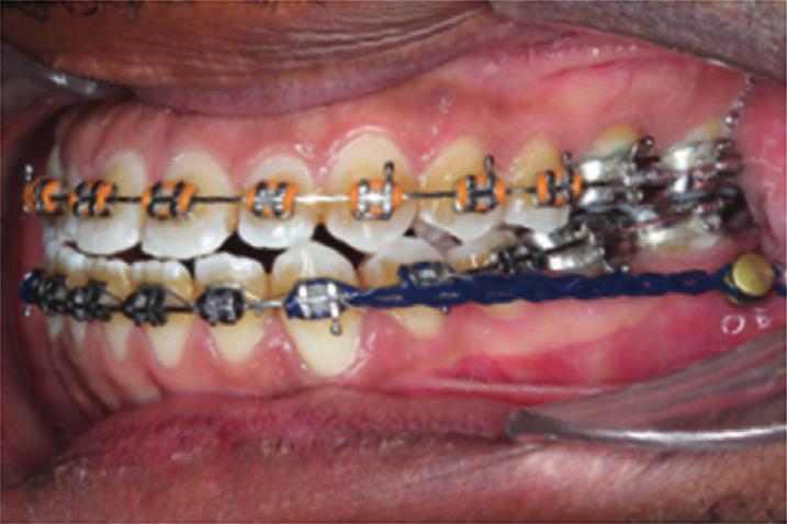 Case Reports in Dentistry 5 (a) (b) Figure 5: Progress intraoral photographs: (a) miniplates are placed on both sides and en masse distalization has just started; (b) the molars are overcorrected to