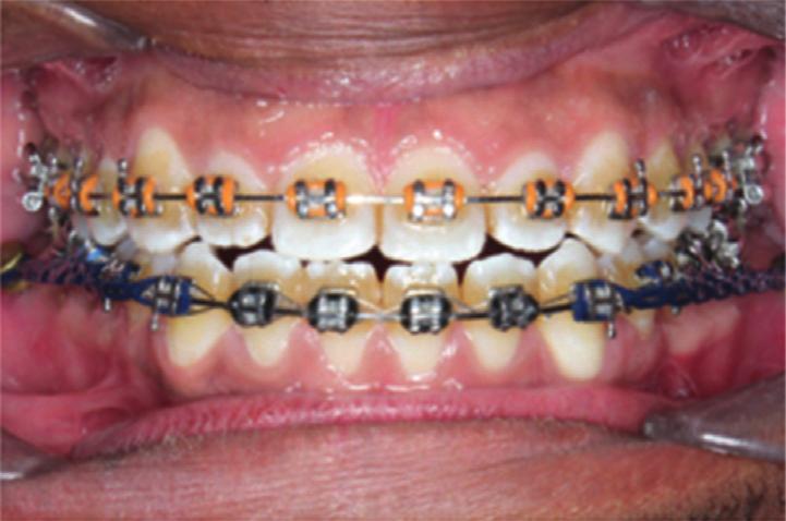 Due to a Bolton discrepancy, a small amount of interproximal enamel reduction was performed on the lower anterior teeth. The total treatment duration was 23 months.