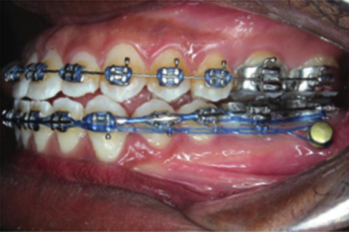 A Class I canine and molar relationship and normal overjet and overbite were achieved as well as closure of the maxillary midline diastema (Figures 6 and 7).