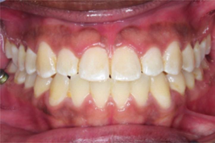 Posttreatment dental
