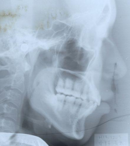 Print on transparent support LATERAL SKULL RADIOGRAPH AT COMPLETION OF