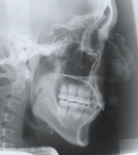 Print on transparent support LATERAL SKULL RADIOGRAPH AT RETENTION /