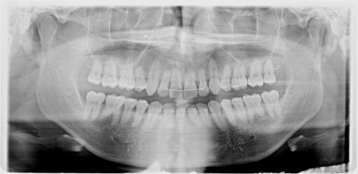 PERIAPICAL OR PANORAMIC RADIOGRAPHS AT RETENTION / POST-RETENTION
